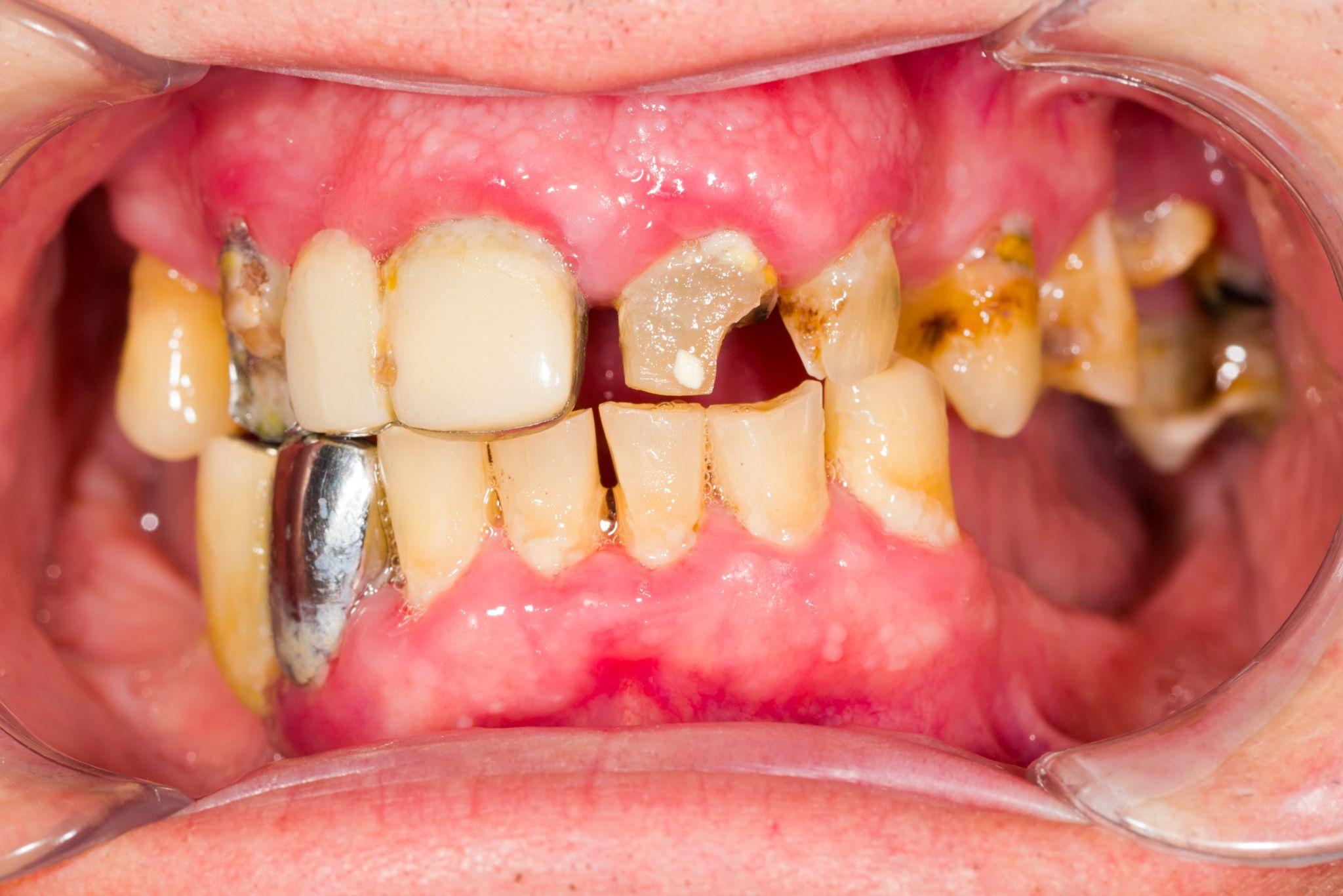 Neglected Denture