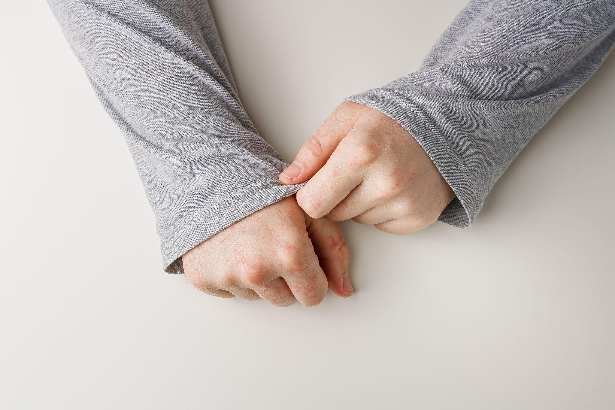 Person hiding hands with red spots on skin with grey sleeves.